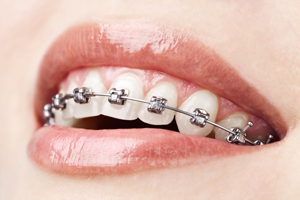 A metal brace on a woman's teeth