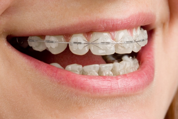 Dental Braces in Singapore (Orthodontists)