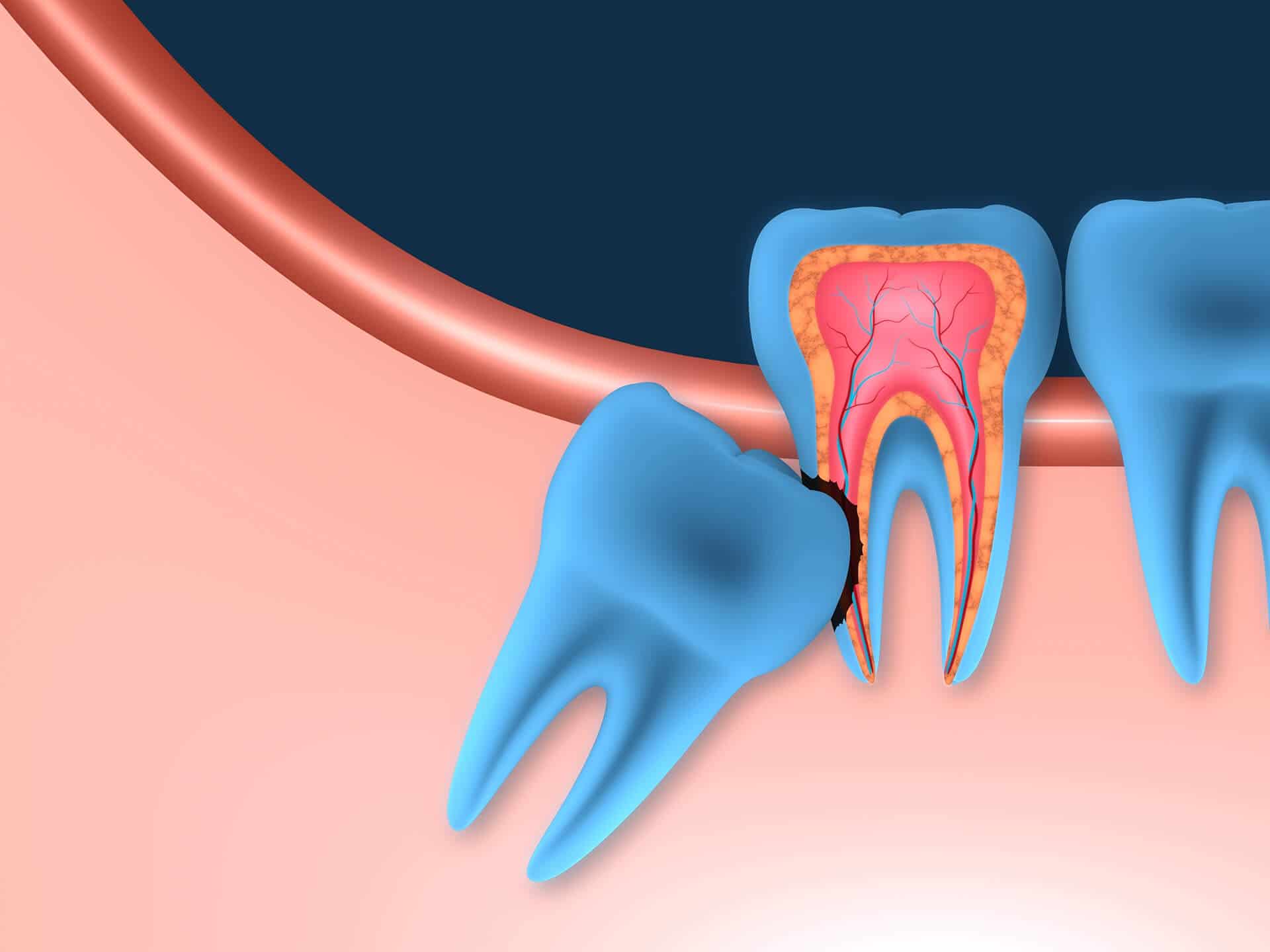 Is Wisdom Teeth Removal Painful Things To Know Before You Get This