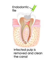 T32 Services Root Canal Treatment - a graphics of a root canal treatment (a part) 1