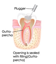 T32 Services Root Canal Treatment - a graphics of a root canal treatment (a part) 2