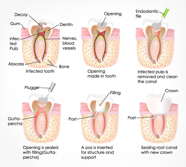 Root canal treatment process