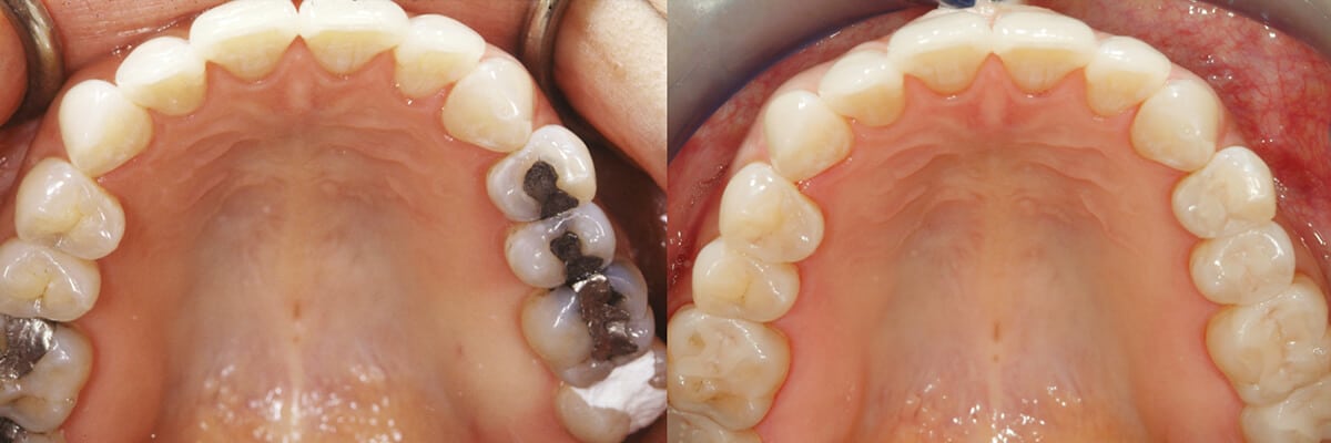 T32Dental-DentalServices-InlaysOnlays-1200px-001