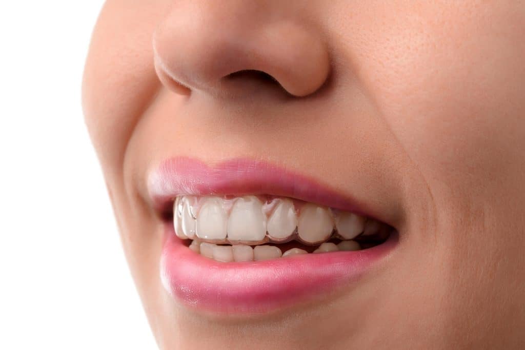 A woman wearing Invisible Braces A woman wearing Invisible Braces