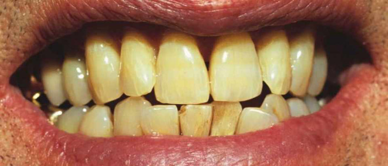 yellow teeth