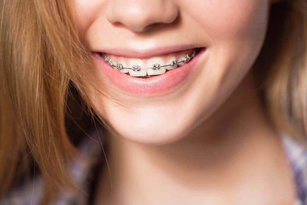 5 Things You Must Know Before Trying Invisible Braces