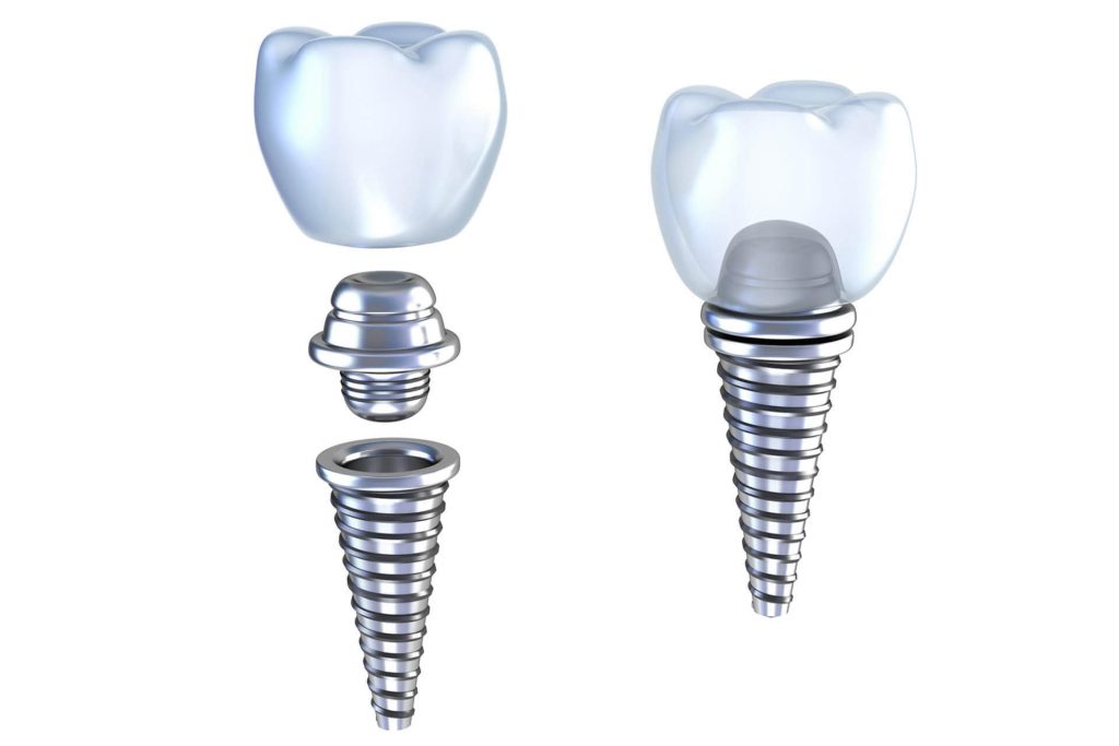 How Dental Implants Can Improve Your Quality of Life 1