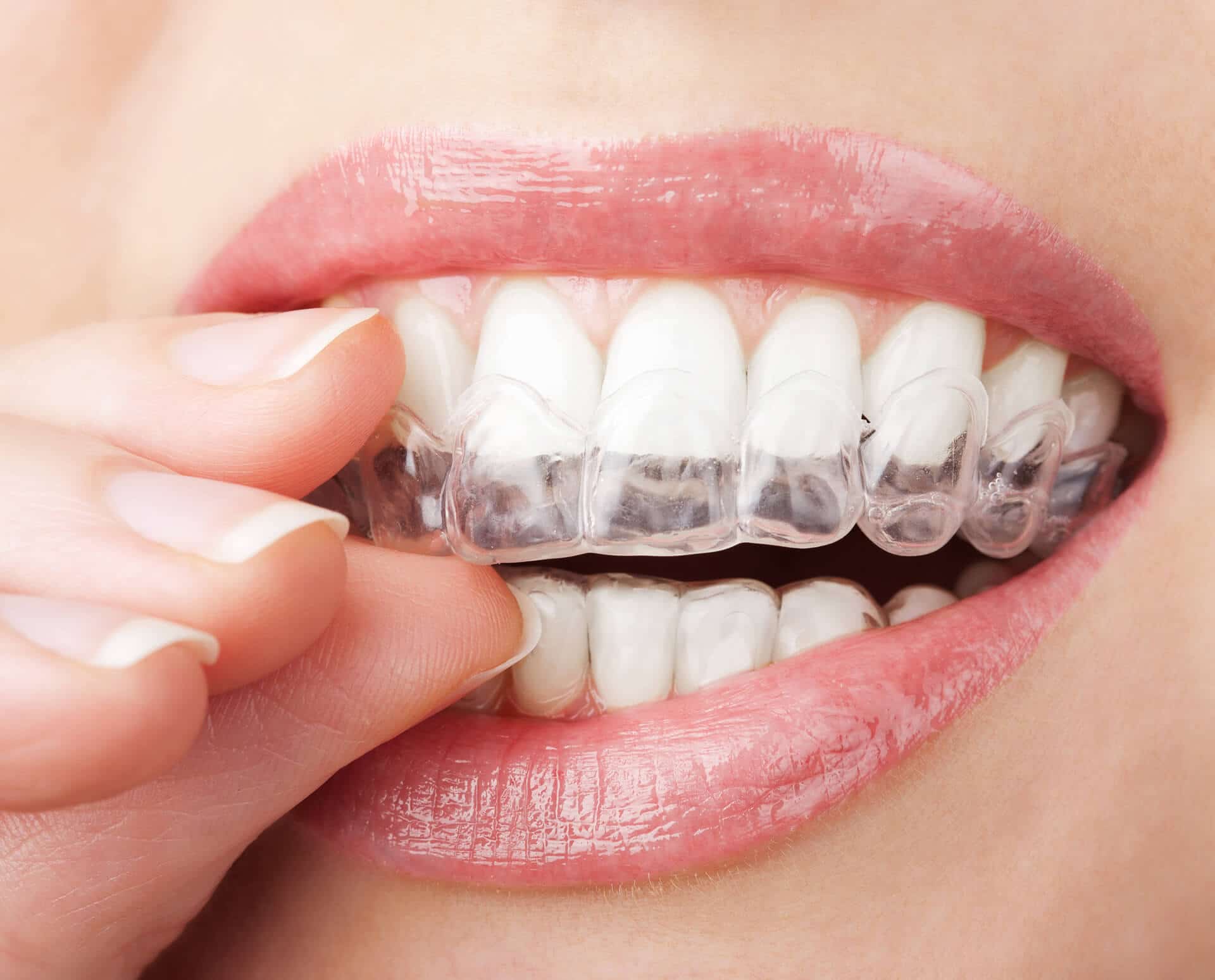 wearing an invisible brace wearing an invisible brace