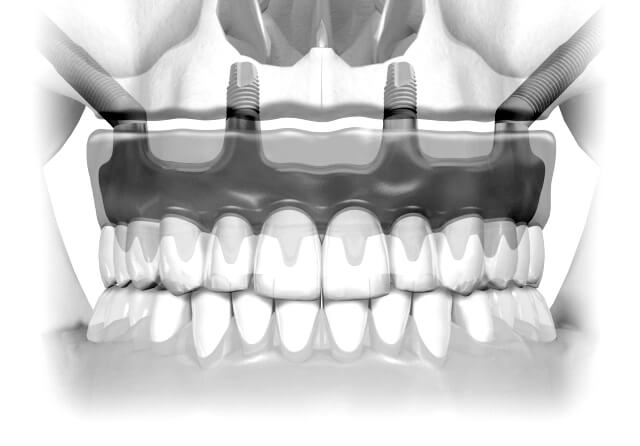 T32Dental Services ProArch Zygo