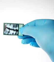 X-ray of misaligned teeth