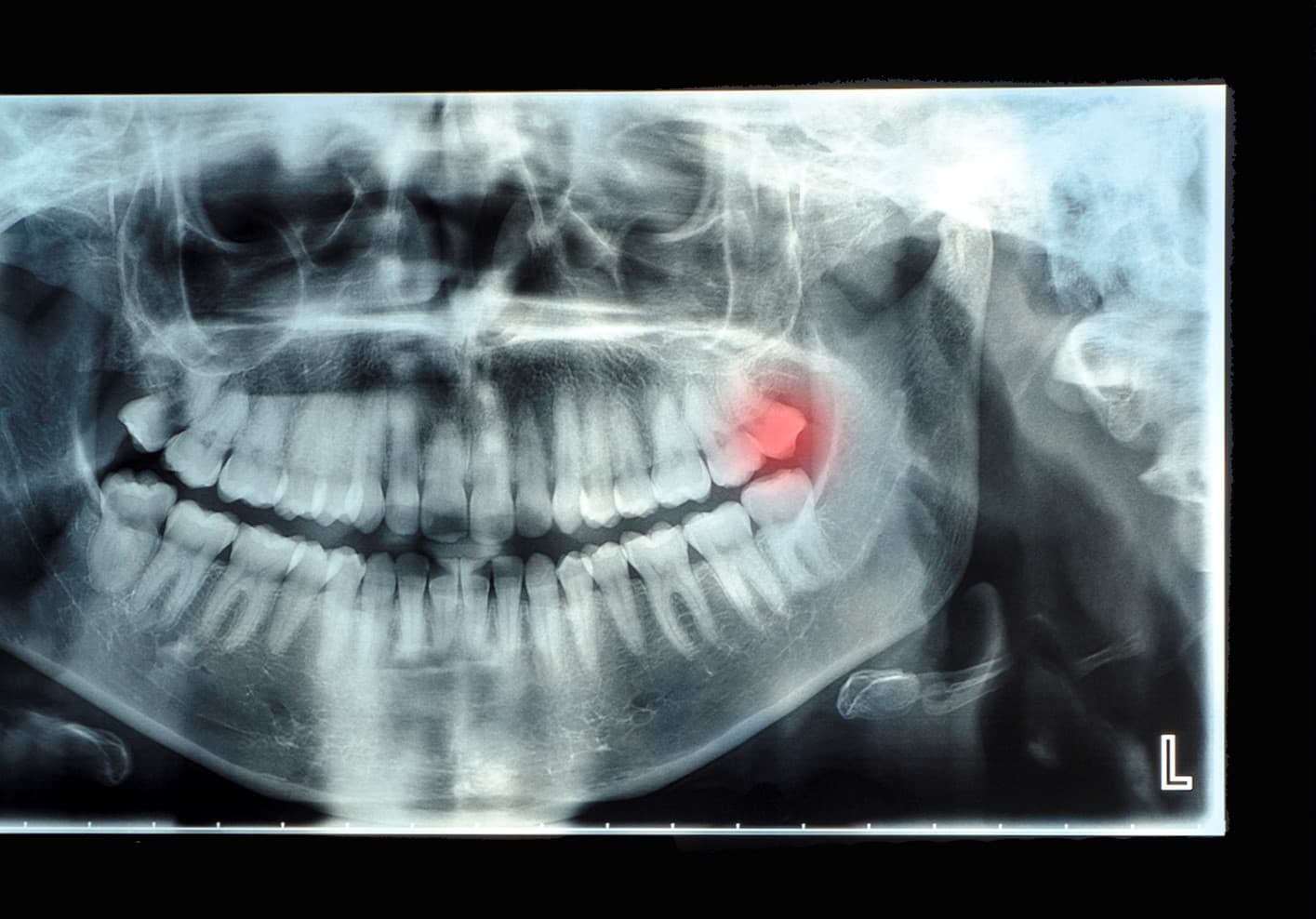 Panoramic dental x-ray with superior upper wisdom tooth (eight tooth) shown red