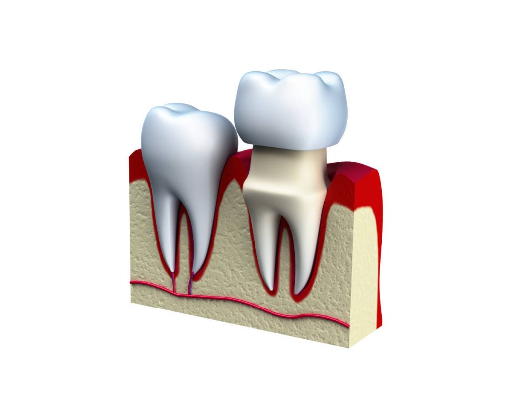 photo-dental-crown-installation-process-isolated 1 ental crown installation process isolated