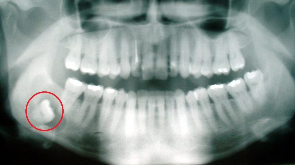 Fun Facts About Wisdom Teeth