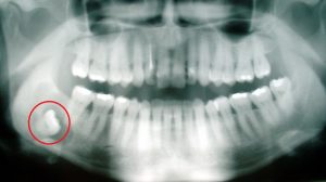 5 wise facts about wisdom teeth_1