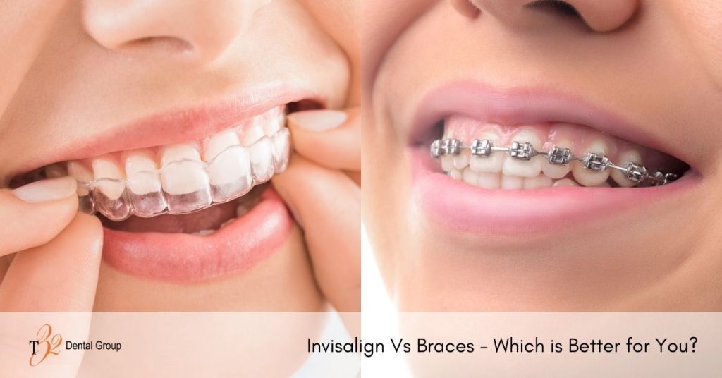 Trident Smiles Dental  Invisalign Aligners vs. Braces: Which is