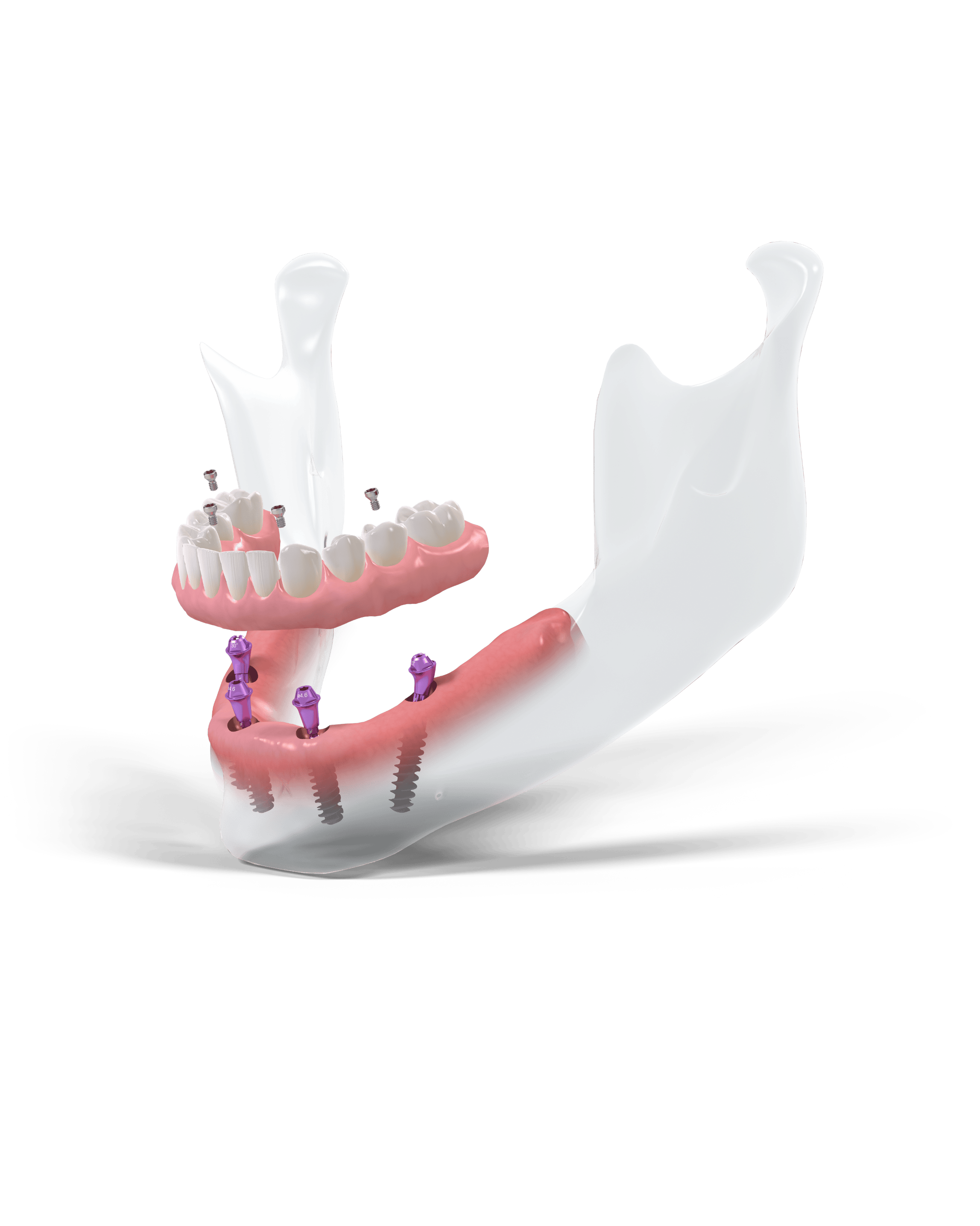 Pro Arch / All On 4 Dental Implant Treatment 1