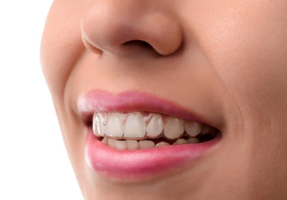 A woman wearing Invisible Braces