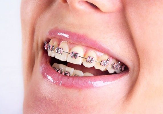 A woman's teeth with braces